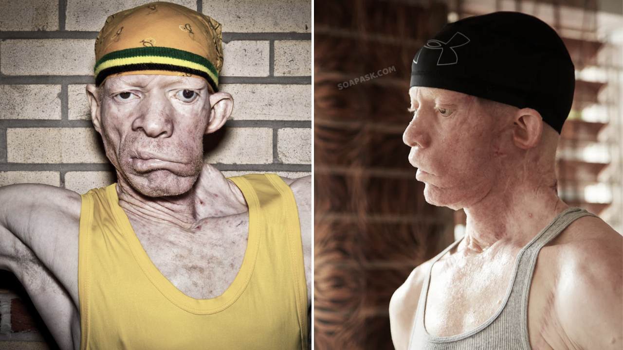 Yellowman undergoes an invasive surgery to remove a tumour from his jaw.