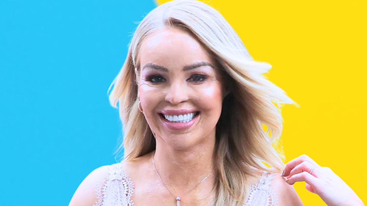 Resilience Unveiled Katie Piper's Journey from Tragedy to Triumph